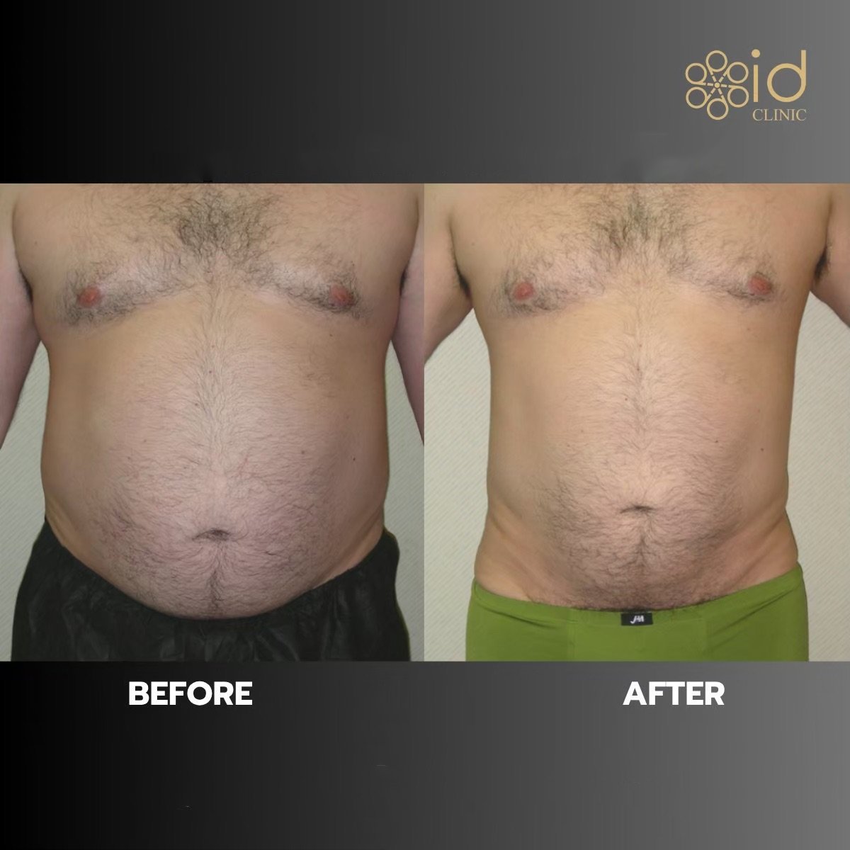 Before and after 360 liposuction results at ID Clinic Bangkok, visible abdominal contouring