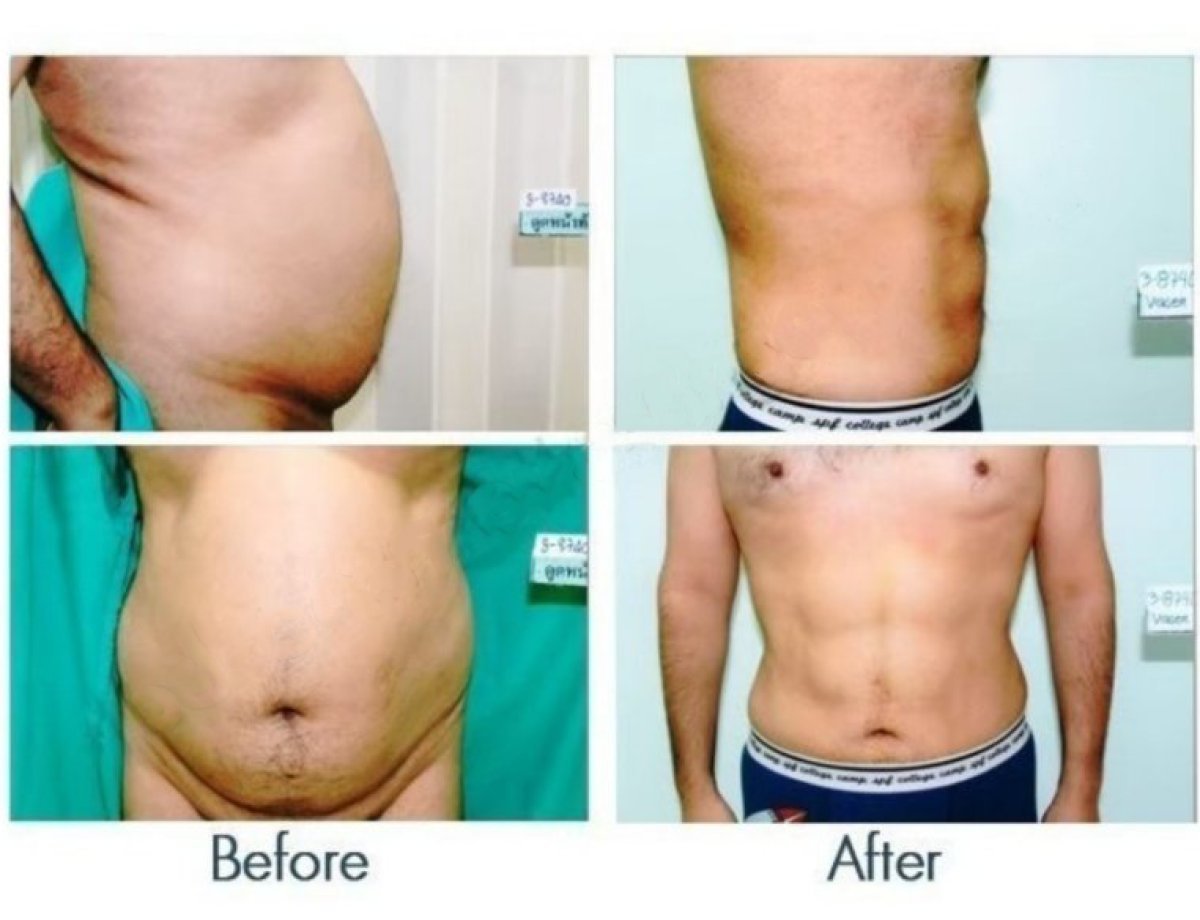 Before and after 360 liposuction results at ID Clinic Bangkok, visible abdominal contouring
