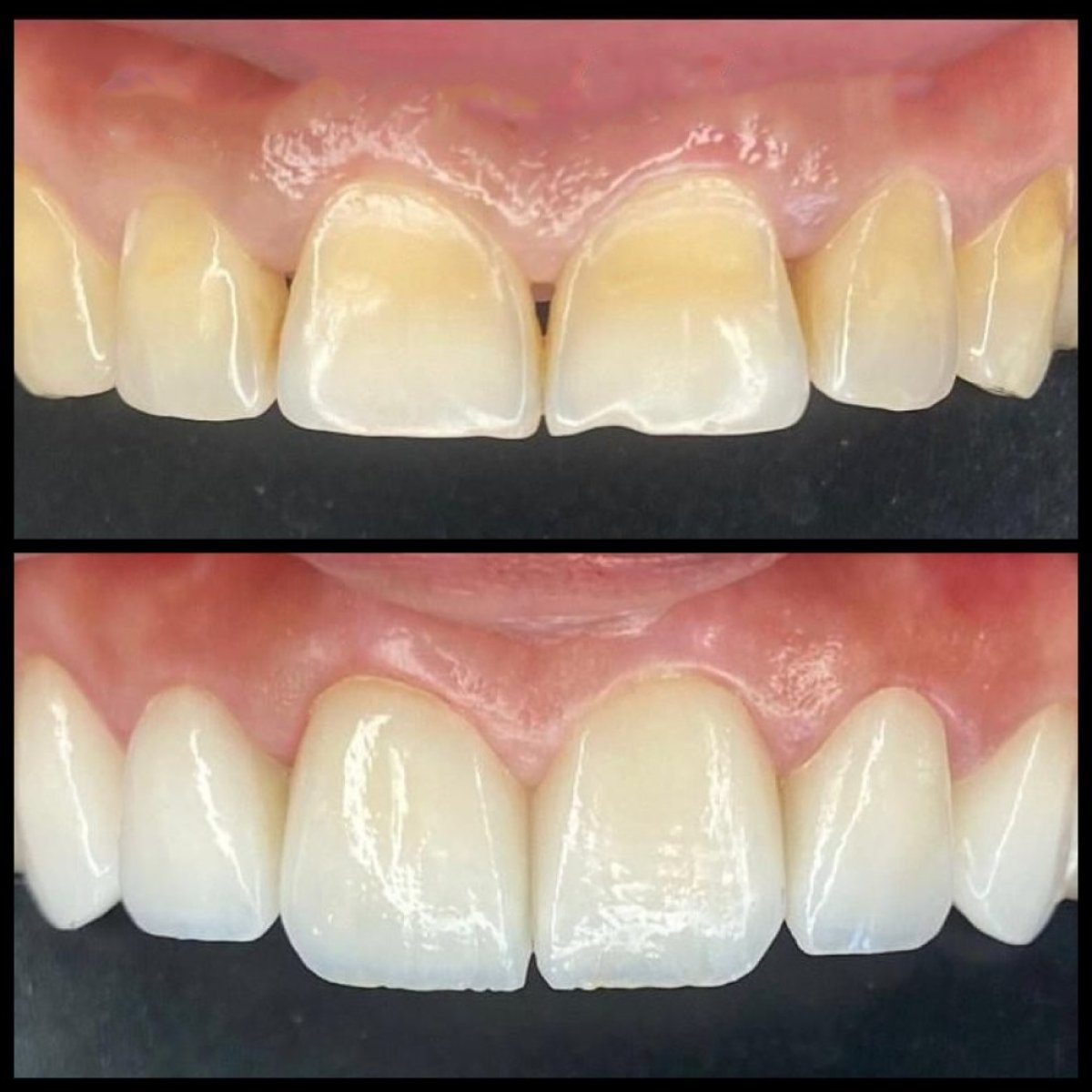 Before and after dental bonding results at Dr. Ela Cabuk Renklibay's Private Dental Clinic