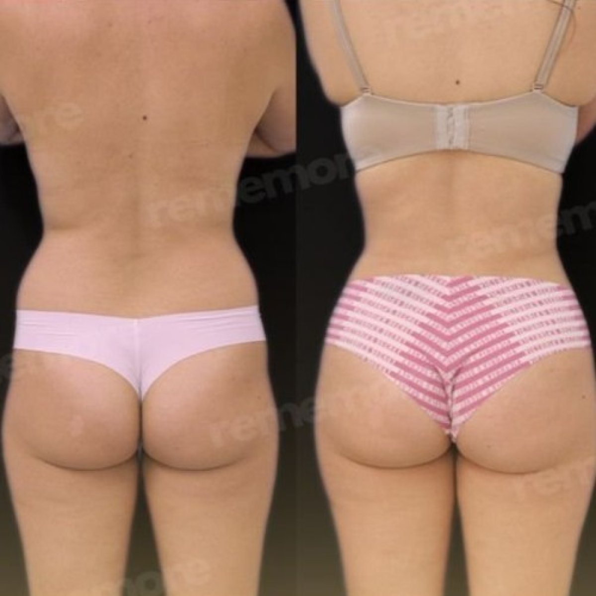 Before and after Renuvion J Plasma body contouring results at Memorial Şişli Hospital