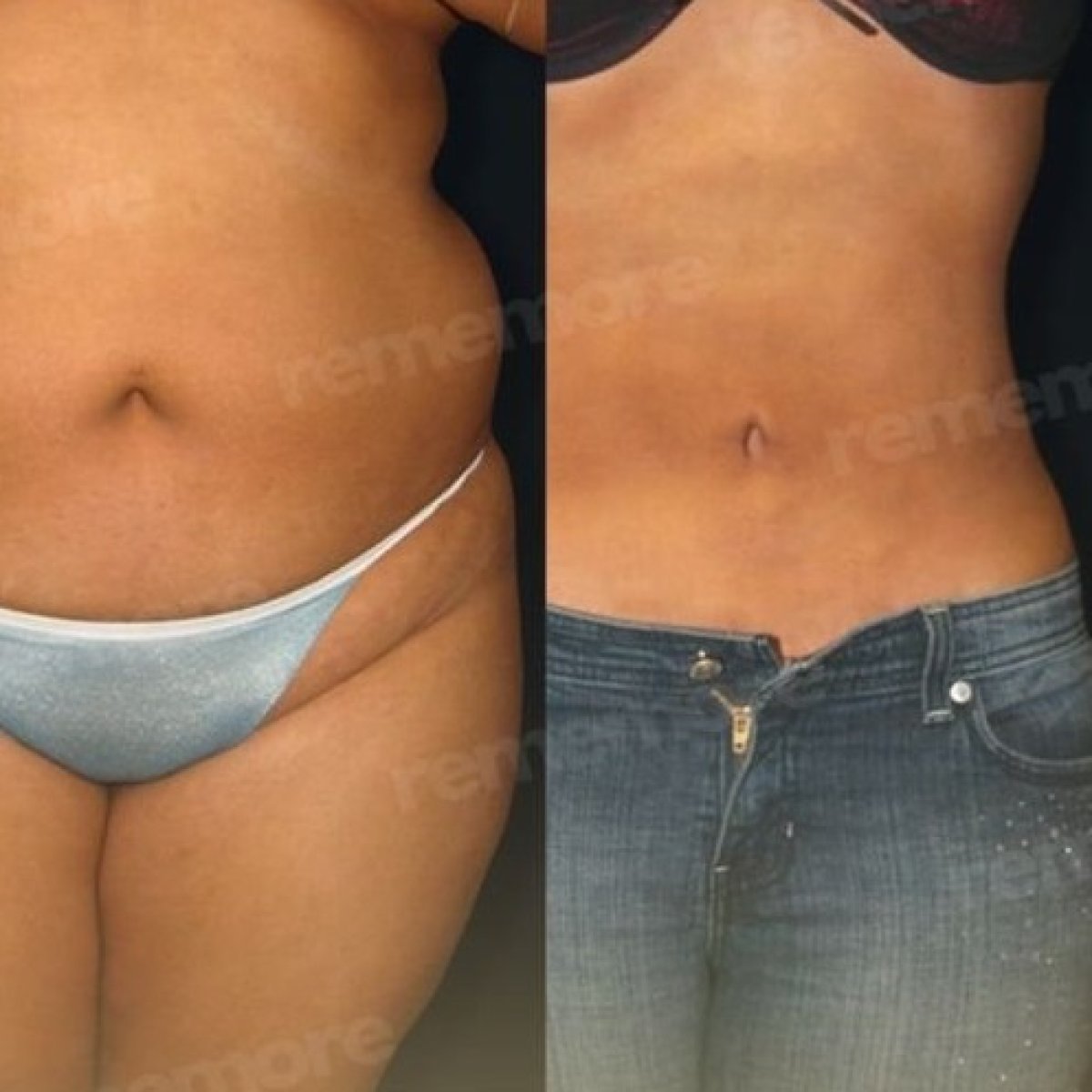 Before and after Renuvion J Plasma body contouring results at Memorial Şişli Hospital