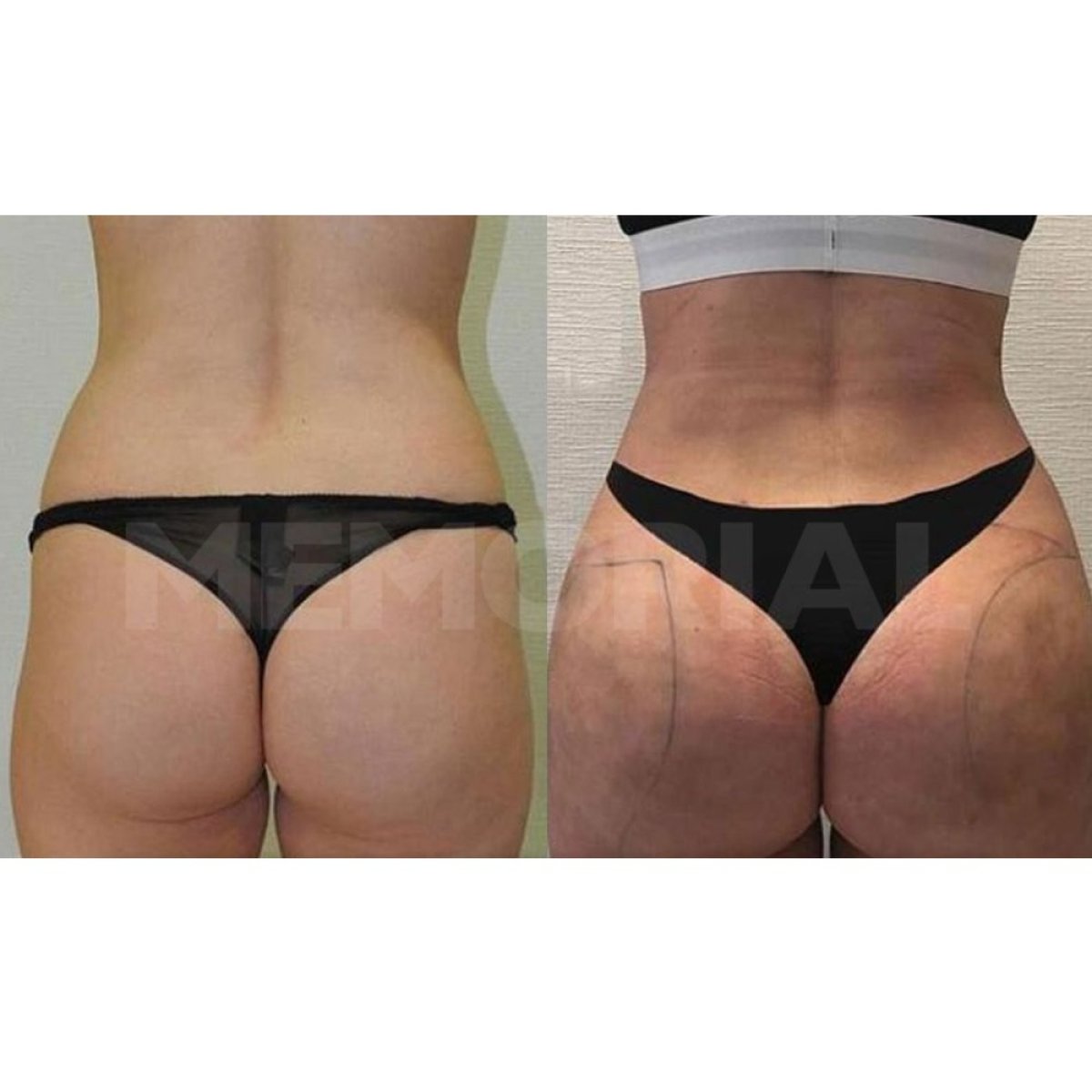 Before and after Brazilian Butt Lift results at Memorial Şişli Hospital, enhanced curves