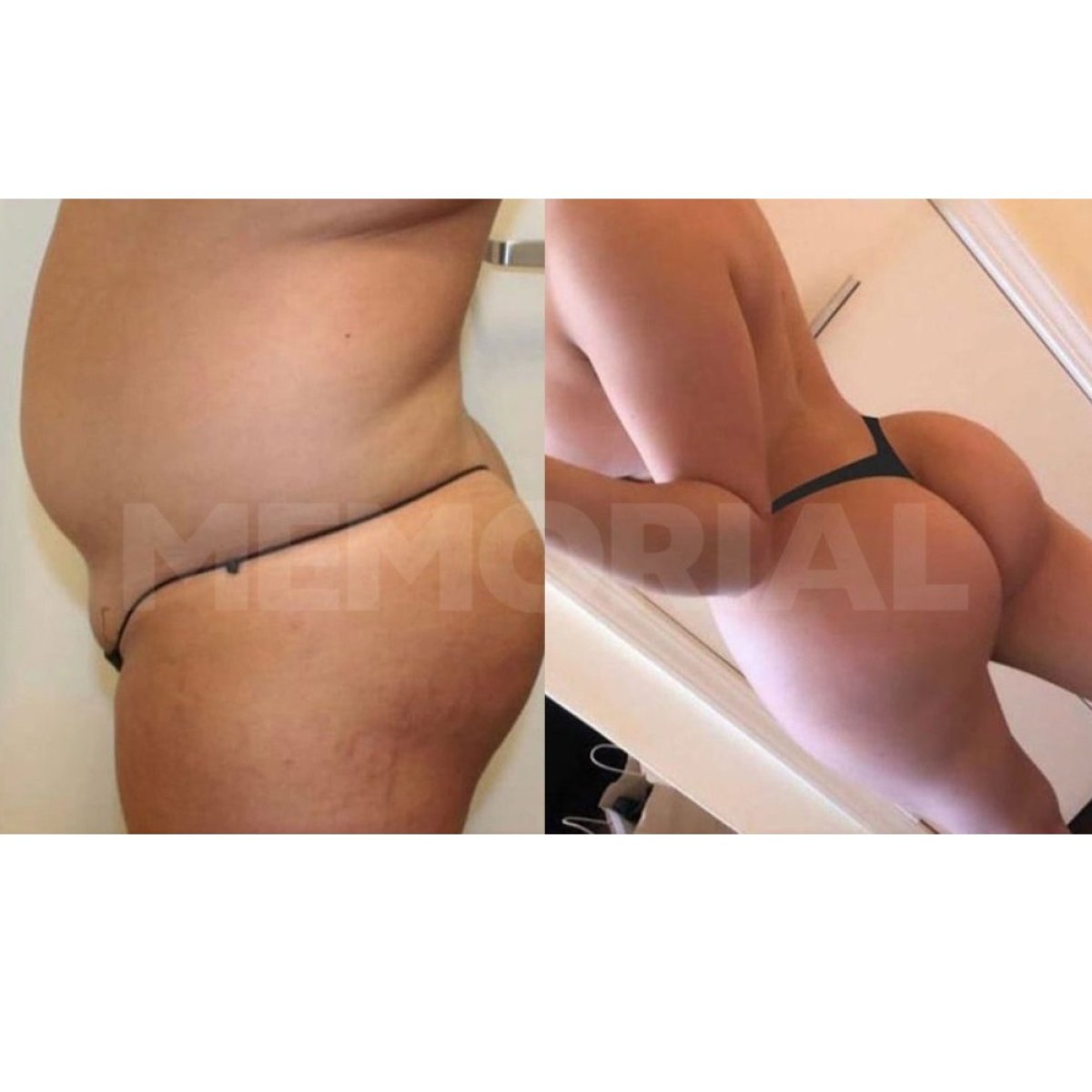 Before and after Brazilian Butt Lift results at Memorial Şişli Hospital, enhanced body contour