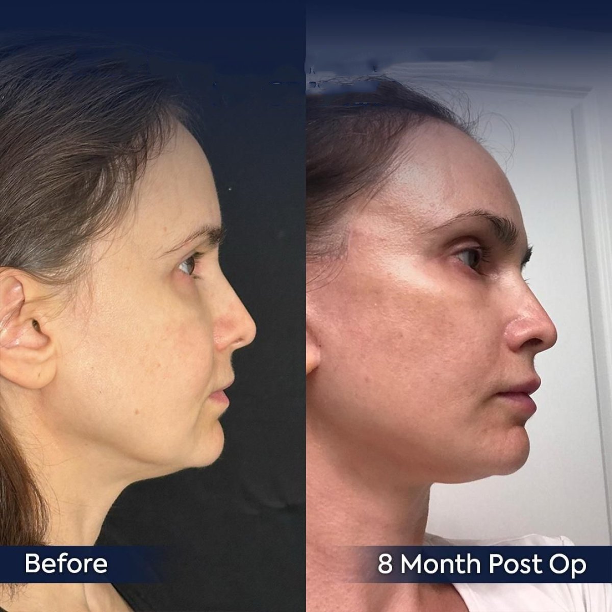Forehead lift before and after results at Dr. Safa Manav Clinic, 8 months post-op improvement
