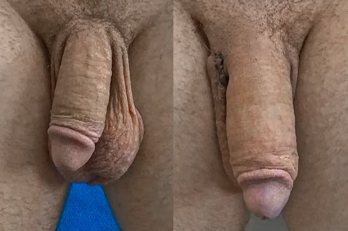 Before and after Himplant penis enlargement surgery results at Uroaesthetic clinic