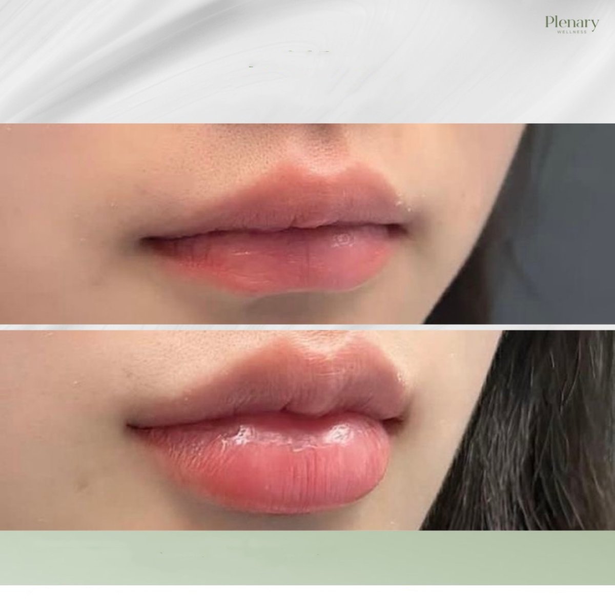 Resultados antes y después de lip lift en Plenary Wellness, contorno y volumen mejorados