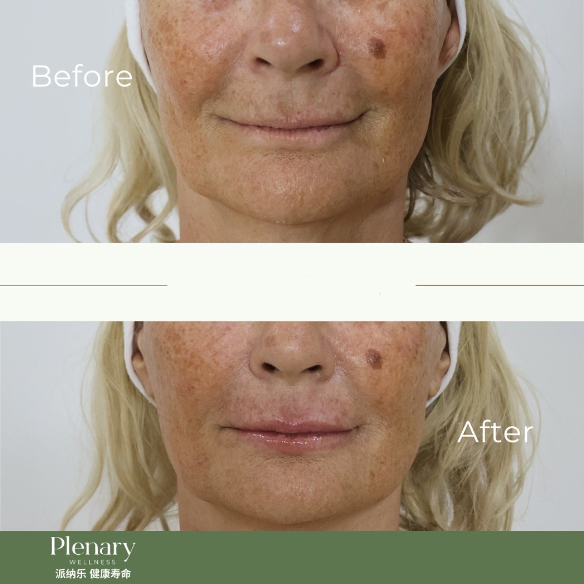 Resultados de lifting de labios antes y después en Plenary Wellness, contorno mejorado