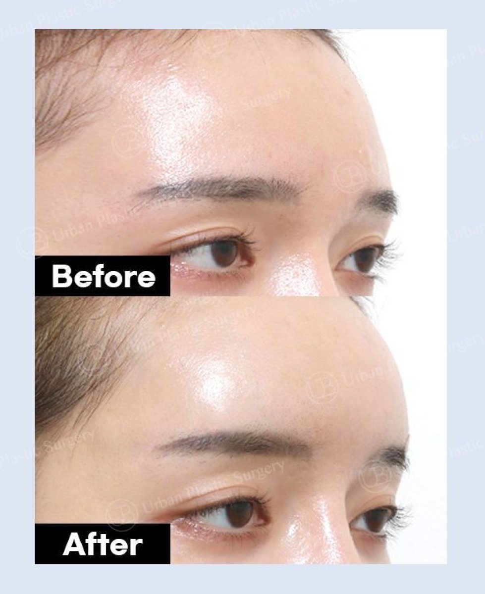 Результаты подтяжки лба до и после в URBAN Plastic Surgery, гладкий контур лба