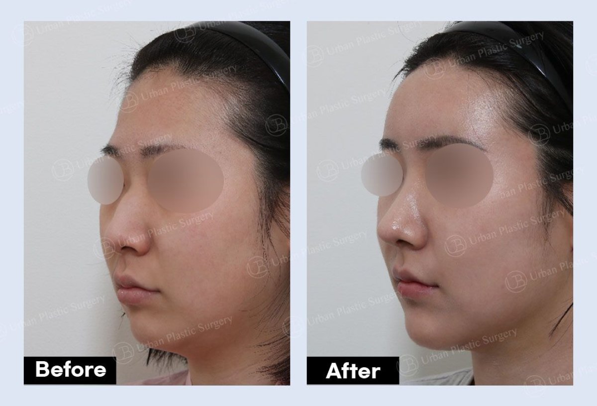 Результати до і після підтяжки чола в URBAN Plastic Surgery, помітний ліфтинг брів