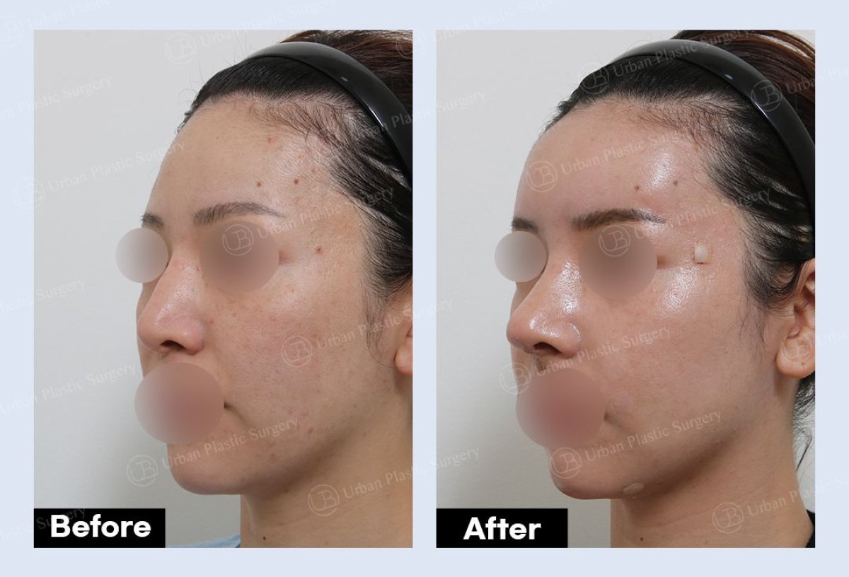 Forehead lift before and after results at URBAN Plastic Surgery, visible brow elevation effect