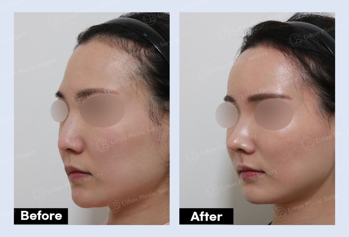 Forehead lift before and after results at URBAN Plastic Surgery, smoother brow appearance