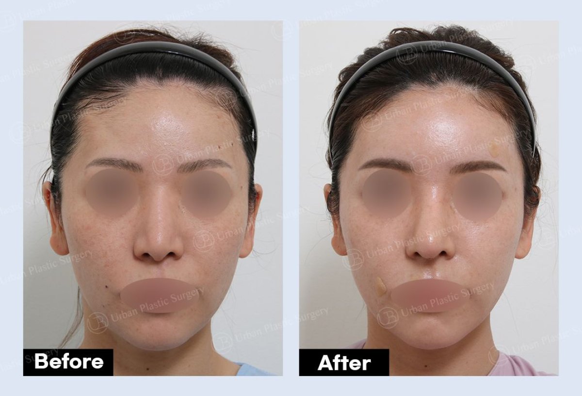 نتائج شد الجبهة قبل وبعد في URBAN Plastic Surgery، رفع واضح للحاجبين