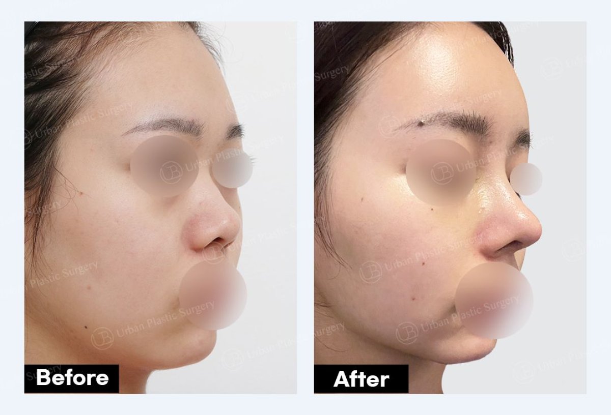 نتائج تجميل الأنف قبل وبعد في URBAN Plastic Surgery، تحسين شكل الأنف والملف الجانبي
