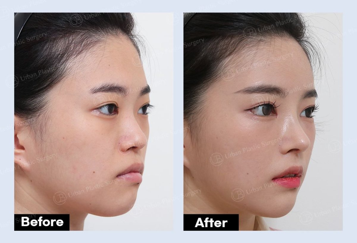 نتائج شد الجبهة قبل وبعد في URBAN Plastic Surgery – منطقة جبين أكثر نعومة ورفعًا