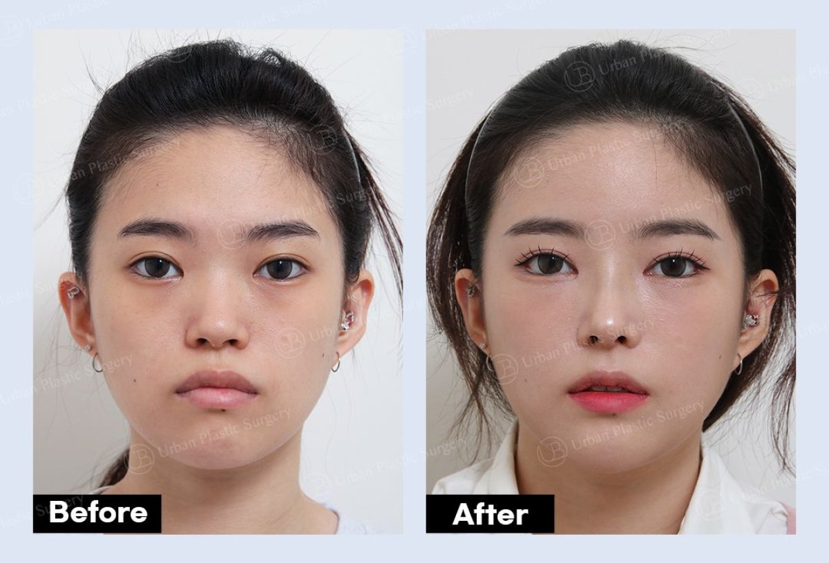 نتائج شد الجبهة قبل وبعد في URBAN Plastic Surgery مع رفع واضح للحاجبين