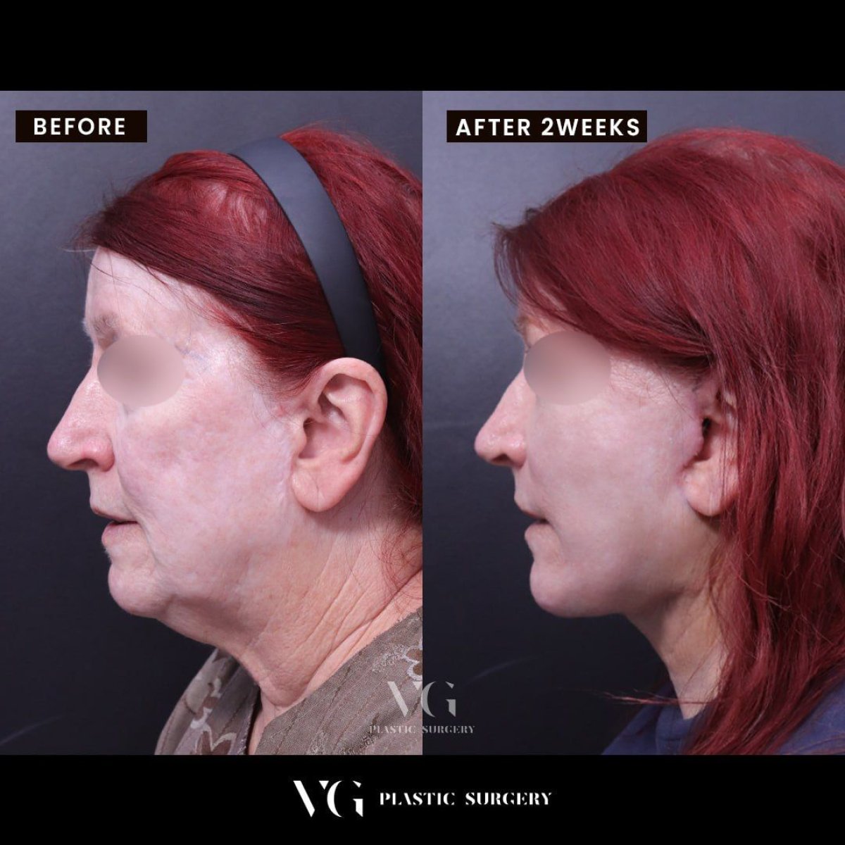 Résultats du lipofilling du visage chez VG Plastic Surgery, restauration du volume facial