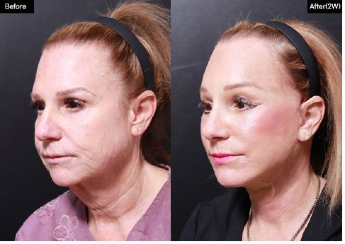 قبل وبعد نقل دهون الوجه في VG Plastic Surgery، نتيجة استعادة حجم الوجه بوضوح