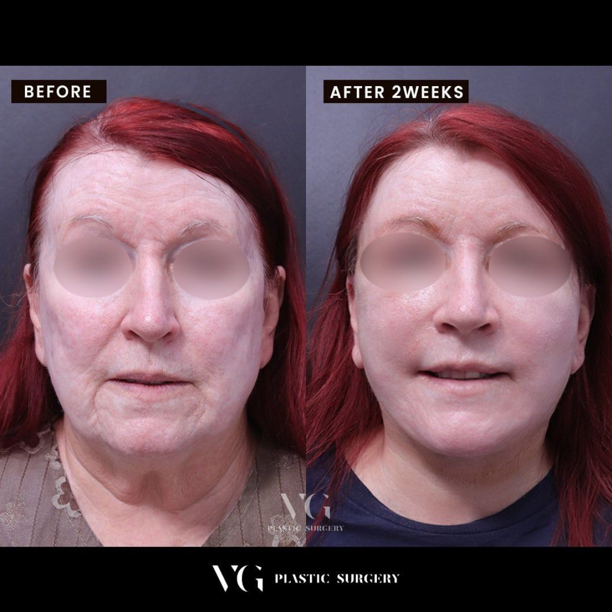 Facial fat transfer before and after results at VG Plastic Surgery, improved facial volume