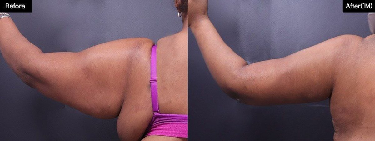 Vorher-nachher-Ergebnis Armliposuktion bei VG Plastic Surgery – verbesserte Kontur