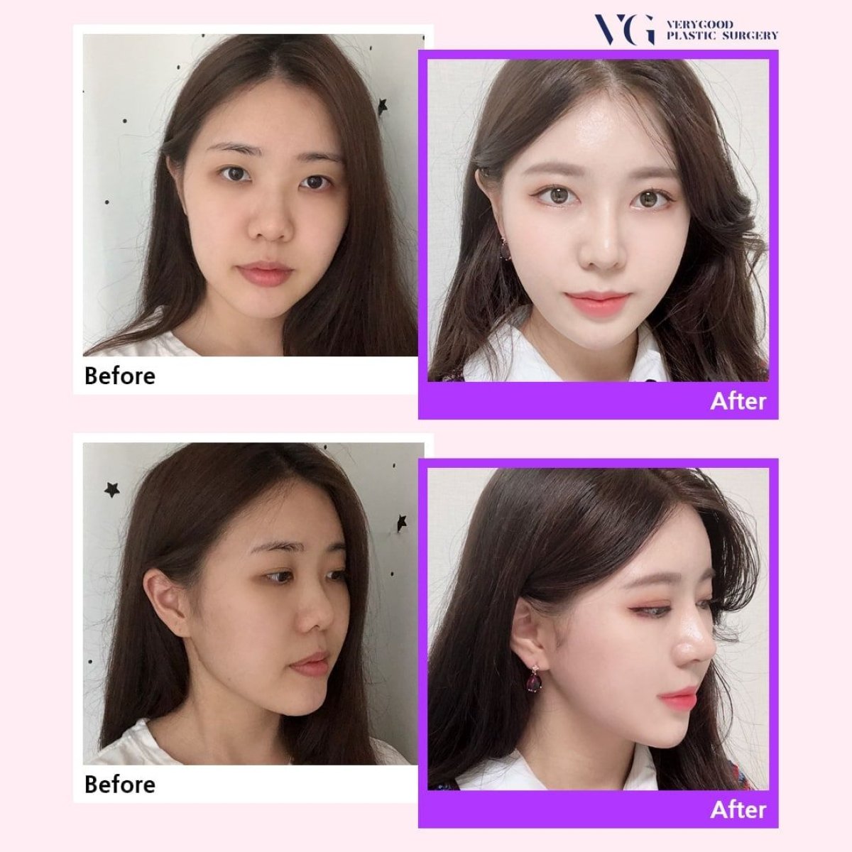 نتائج قبل وبعد عملية تجميل الأنف المفتوحة في VG Plastic Surgery، تحسين شكل الأنف