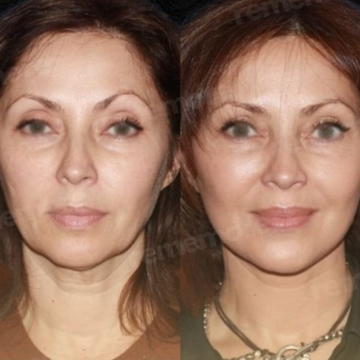 Résultats avant/après mini lifting au Memorial Antalya Hospital, rajeunissement du visage