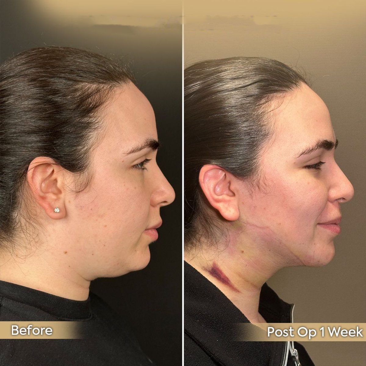 Before and after buccal fat extraction at Dr. Safa Manav Clinic, slimmer facial contour result