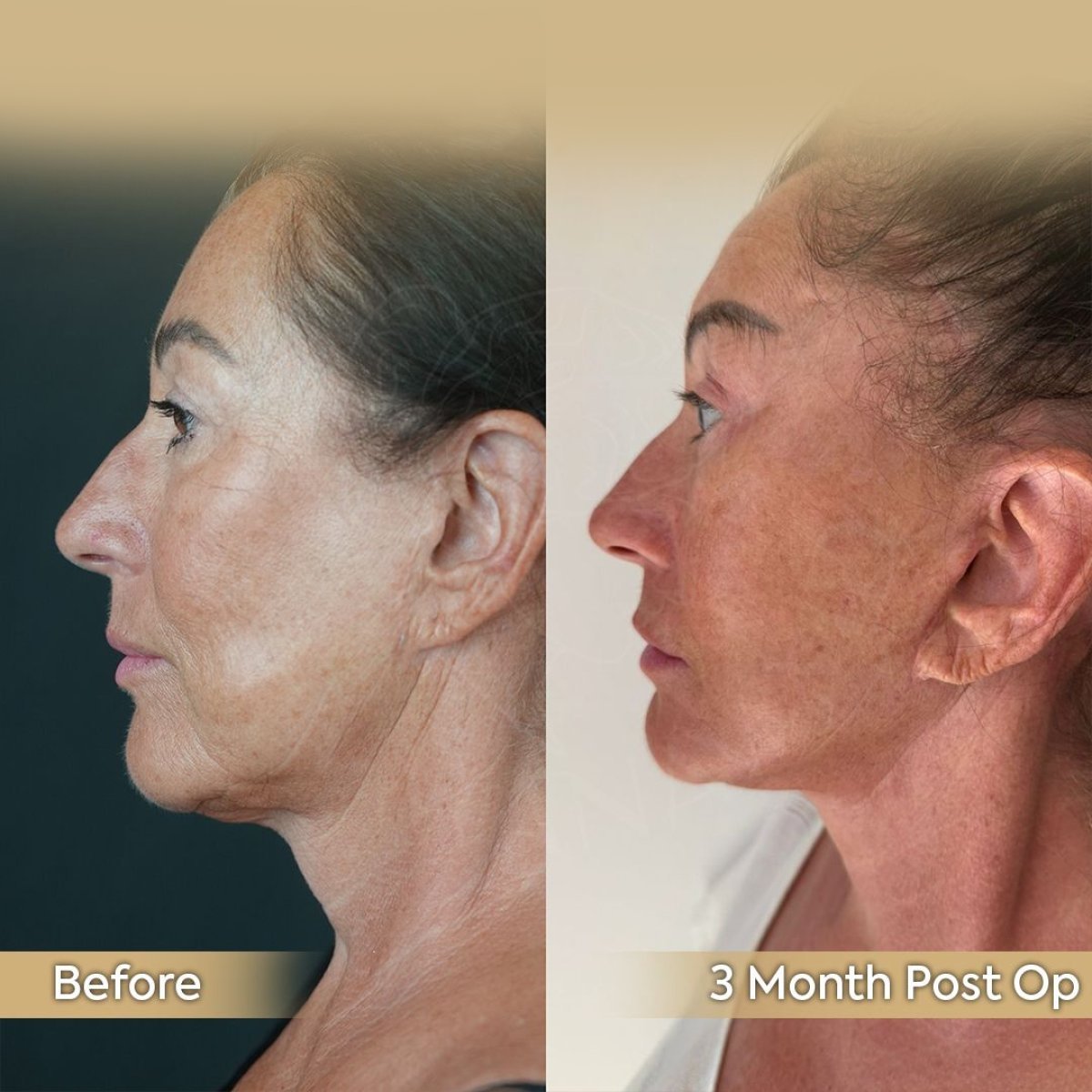 Resultados de lifting facial antes y después en Dr. Safa Manav Clinic, rejuvenecimiento visible