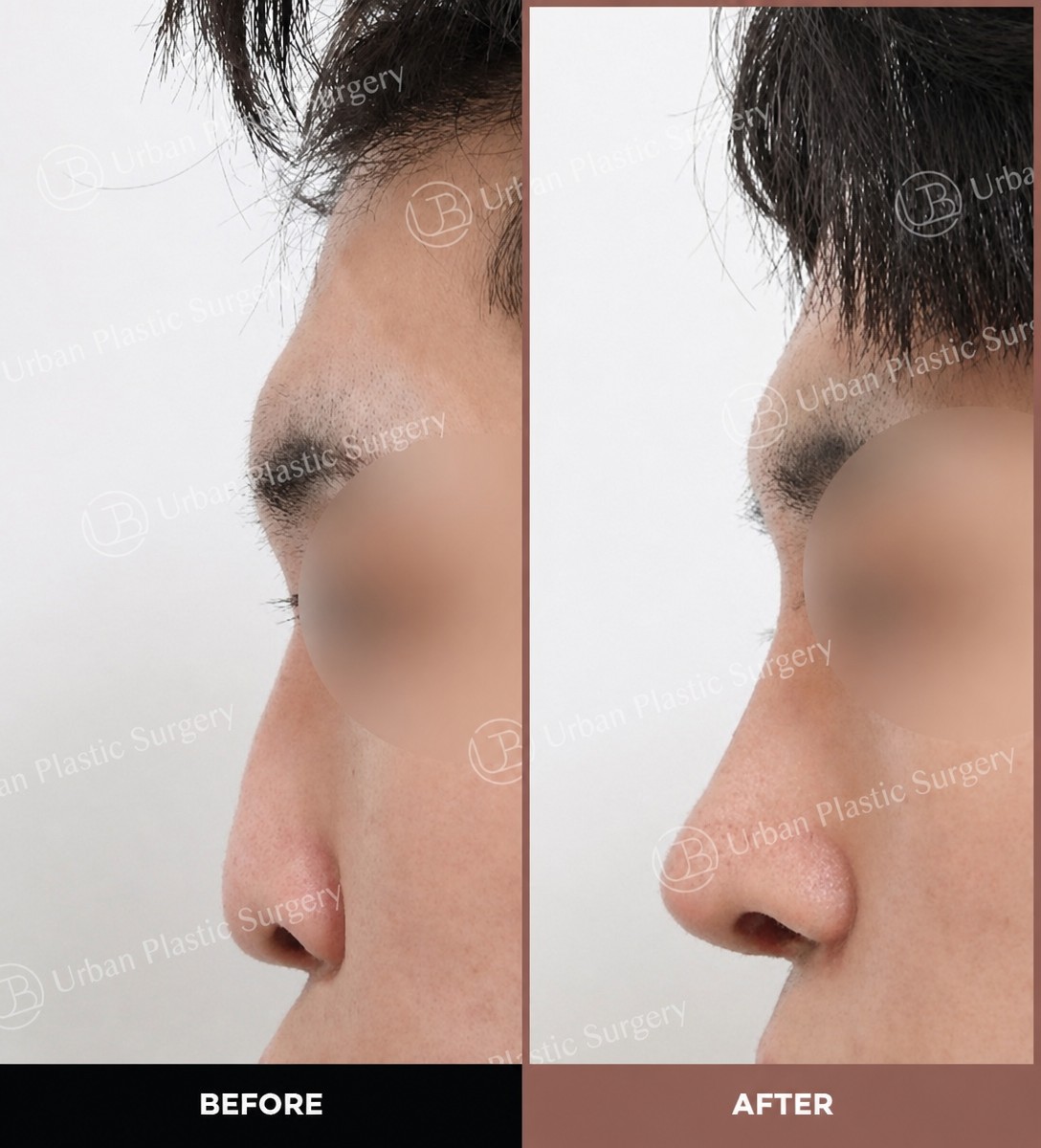 Résultats avant et après rhinoplastie ouverte chez URBAN Plastic Surgery, profil du nez amélioré
