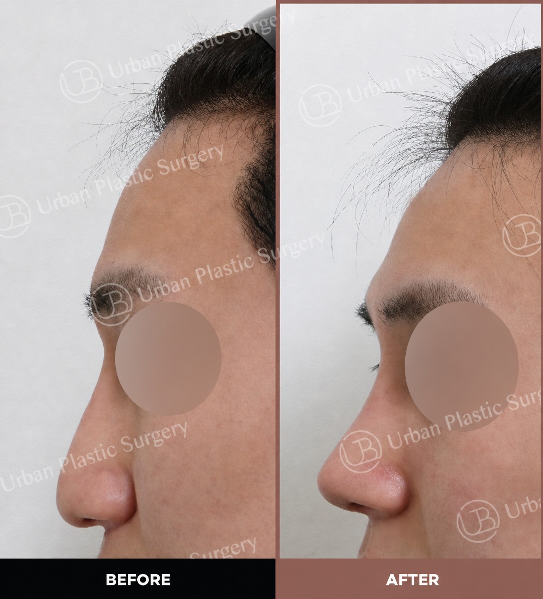 Résultats avant et après rhinoplastie ouverte chez URBAN Plastic Surgery, profil du nez amélioré