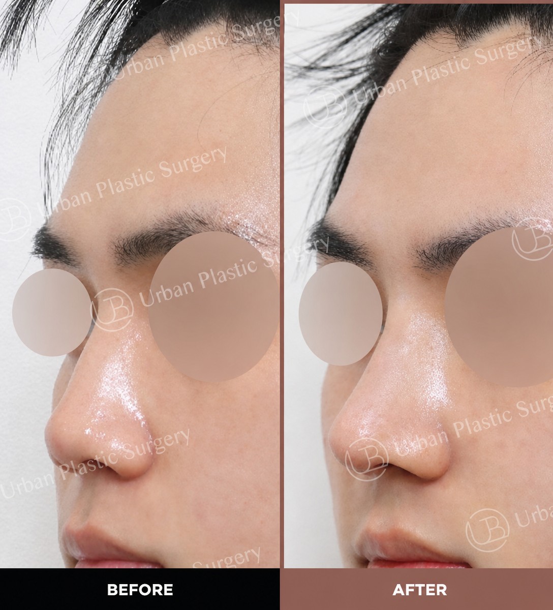 Before and after open rhinoplasty results at URBAN Plastic Surgery, improved nose shape