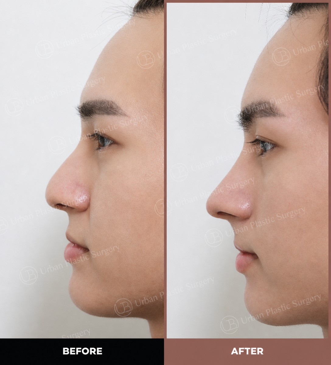 Результаты до и после открытой ринопластики в URBAN Plastic Surgery, улучшенный профиль носа