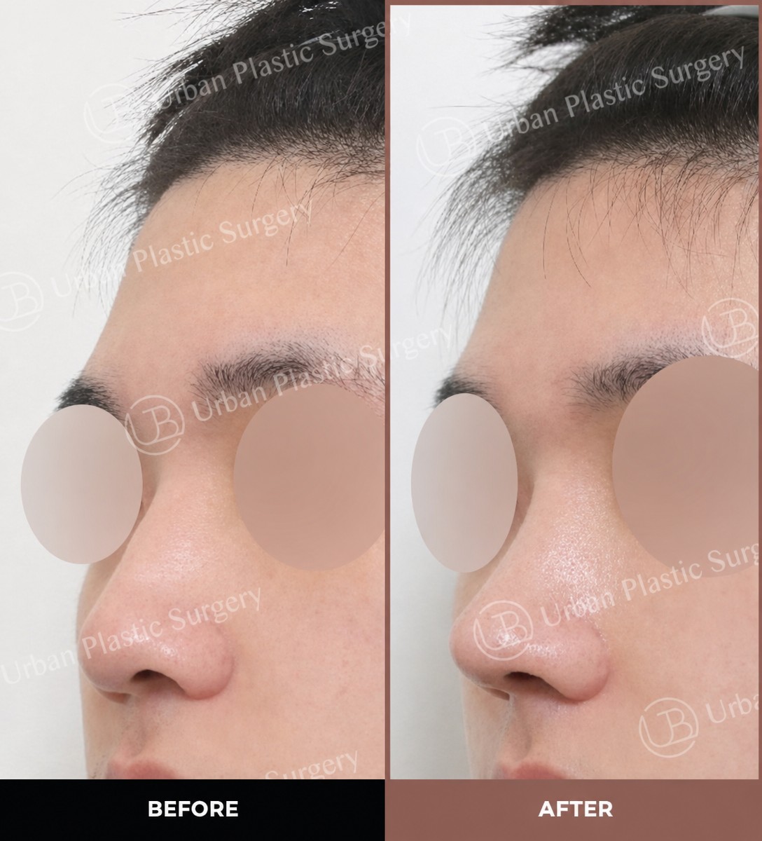 Результаты до и после открытой ринопластики в URBAN Plastic Surgery, коррекция носа