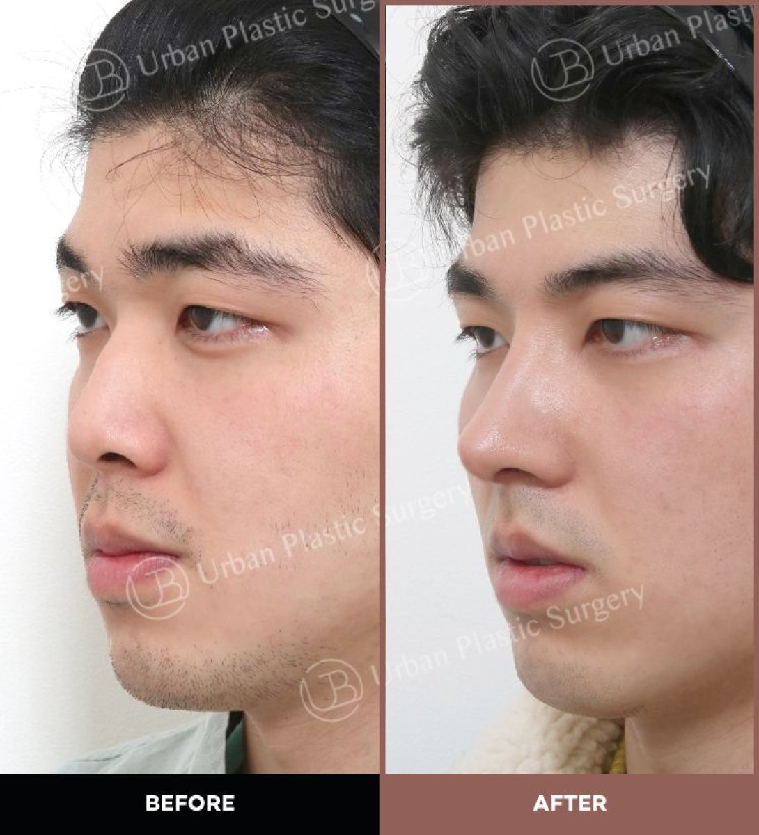 نتائج قبل وبعد عملية تجميل الأنف المفتوحة في URBAN Plastic Surgery، تحسين شكل الأنف