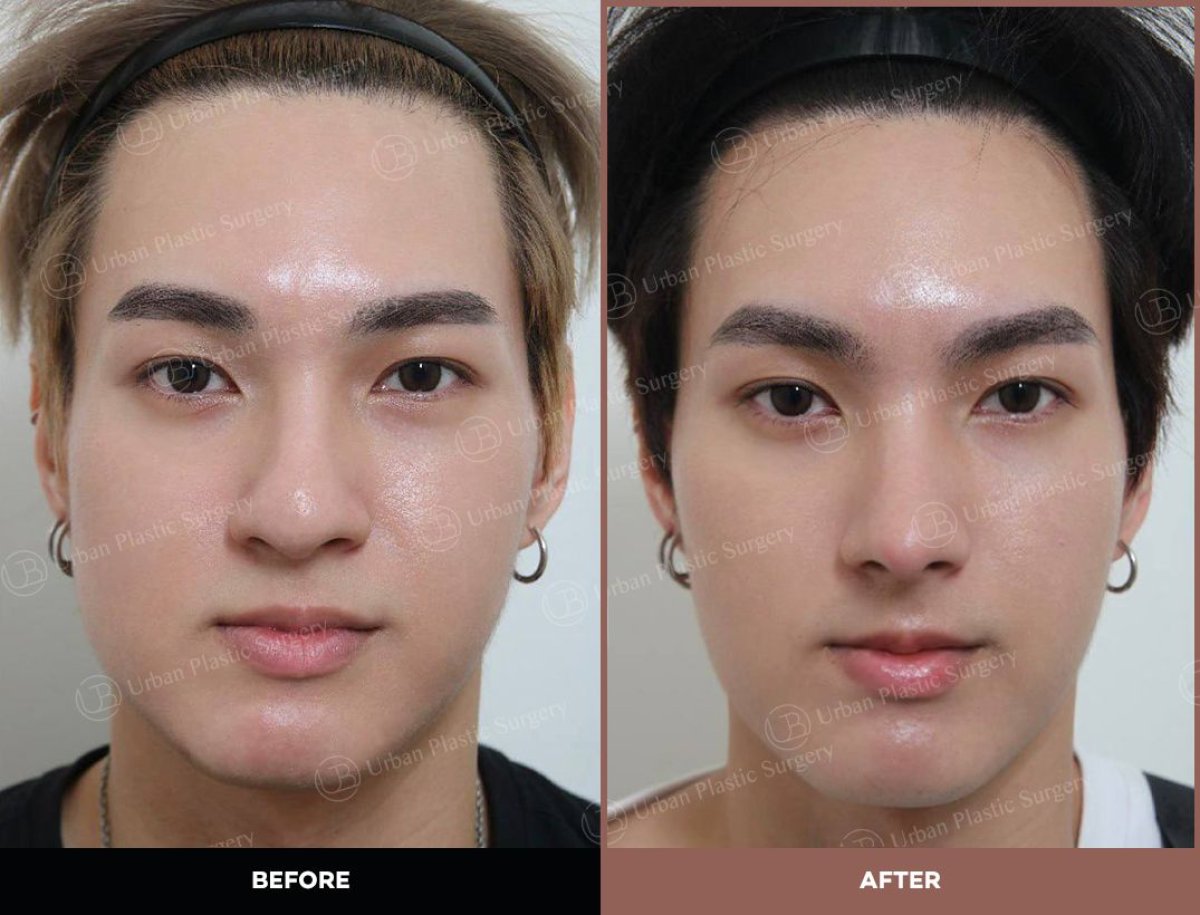 نتائج قبل وبعد عملية تجميل الأنف المفتوحة في URBAN Plastic Surgery، إعادة تشكيل الأنف
