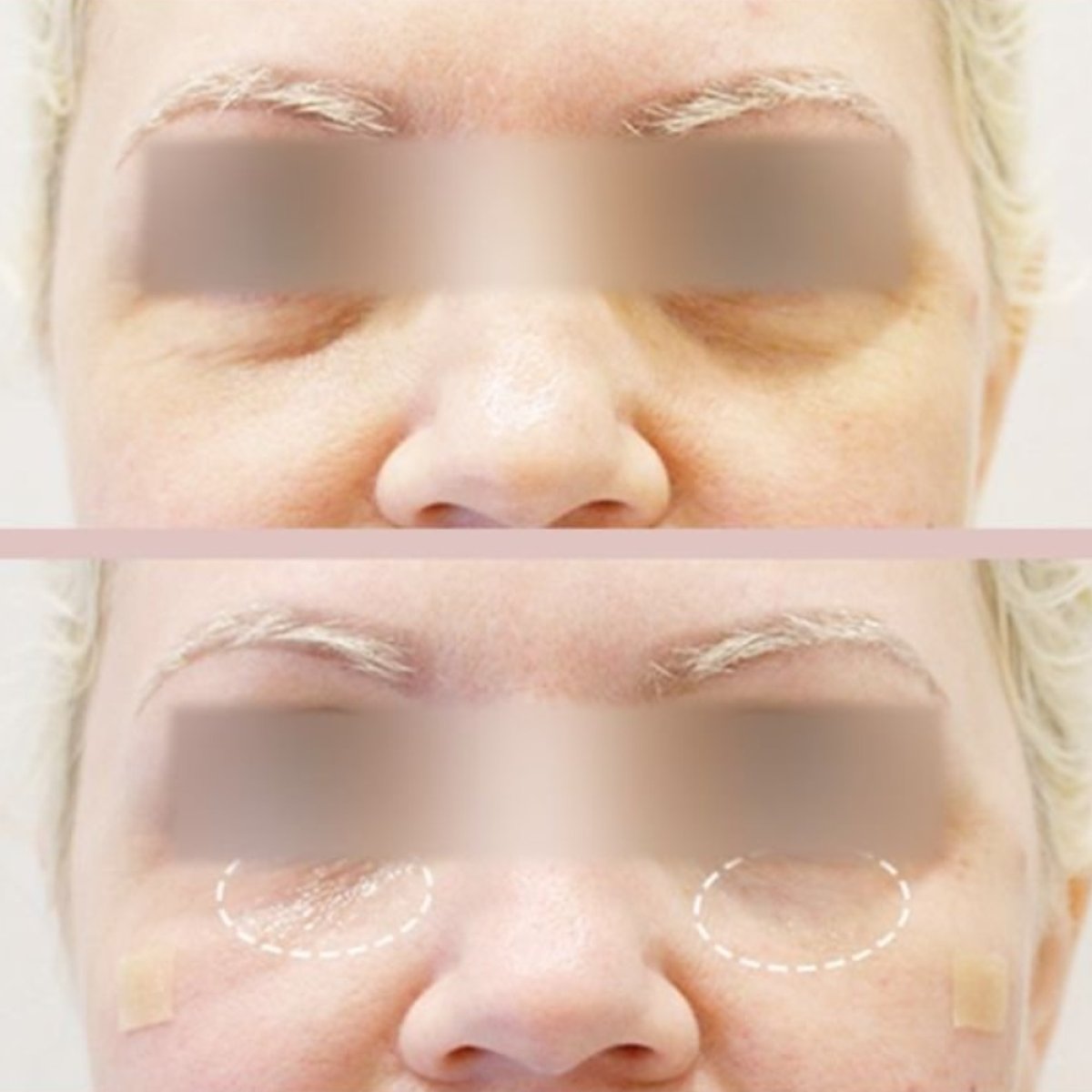 Before and after laser skin resurfacing results at Forena Clinic, improved under-eye area