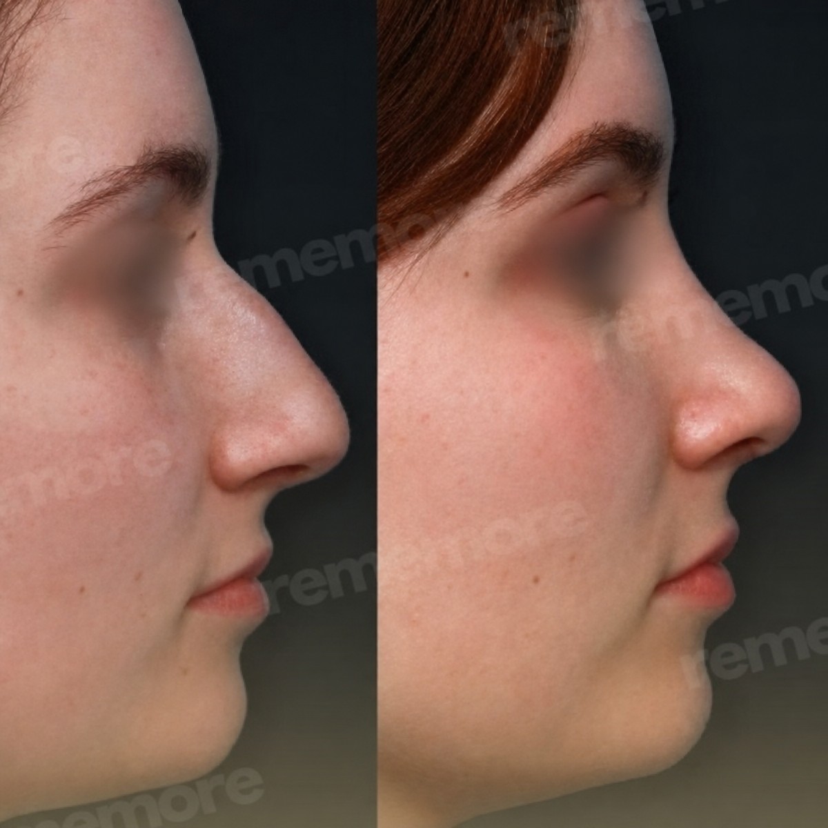 Before and after tip rhinoplasty results at Memorial Şişli Hospital, refined nose shape