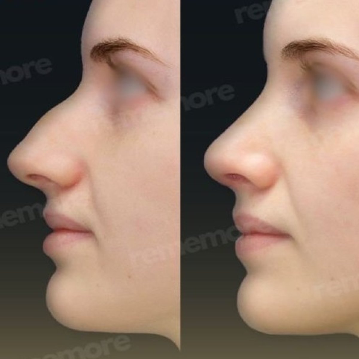 Before and after tip rhinoplasty results at Memorial Şişli Hospital, refined nose shape