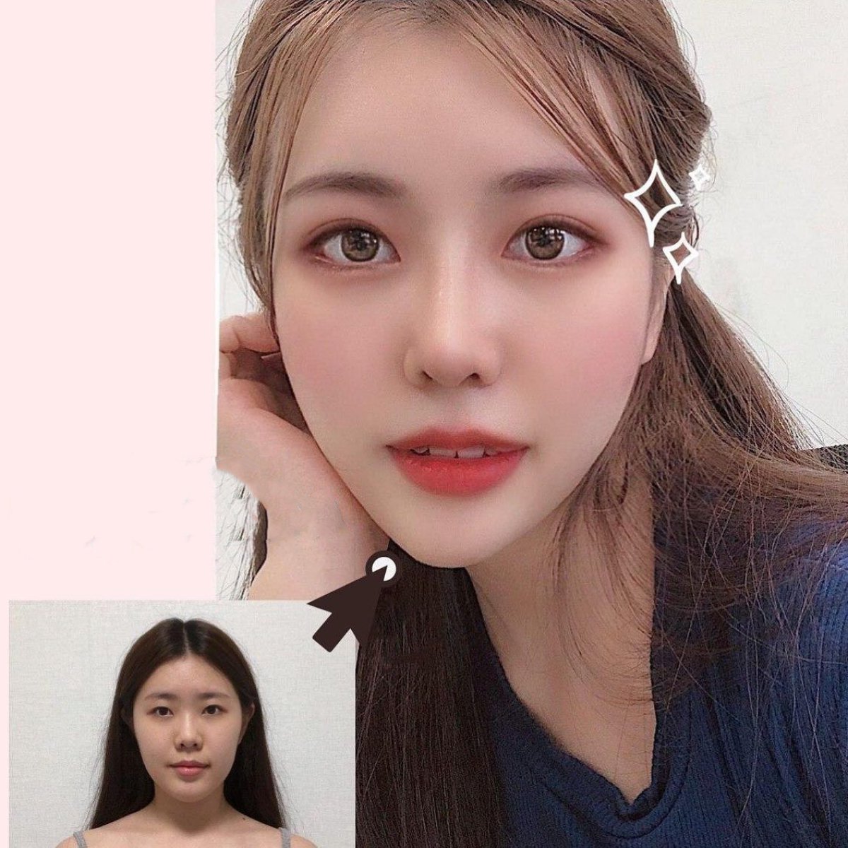 نتائج قبل وبعد عملية تجميل الأنف المفتوحة في VG Plastic Surgery، تحسين شكل الأنف