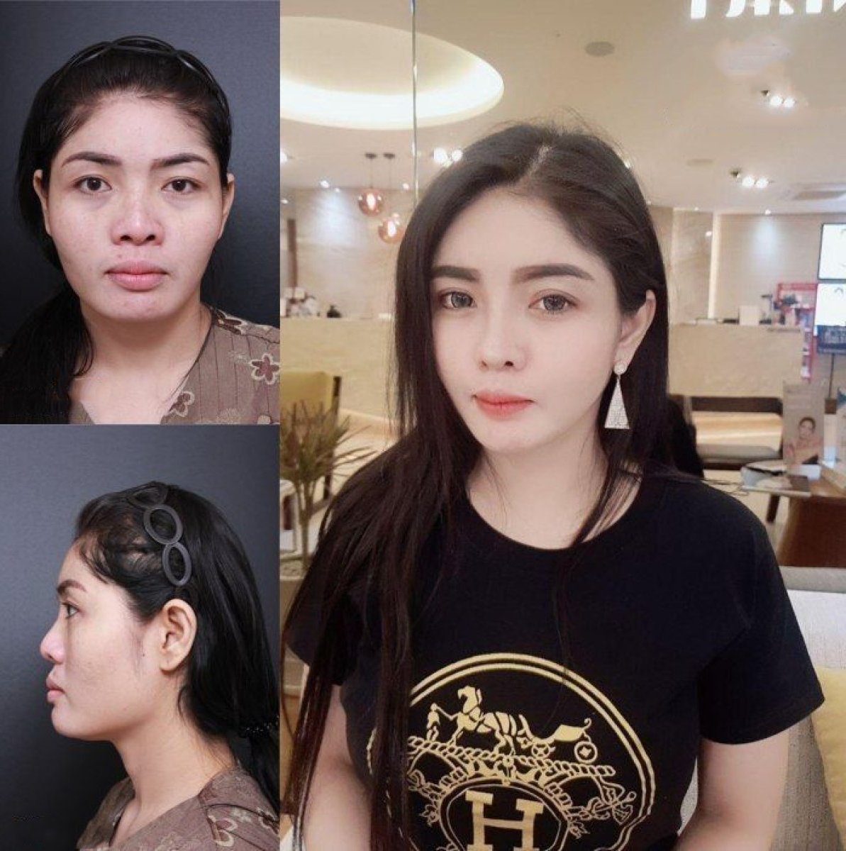 نتائج قبل وبعد عملية تجميل الأنف المفتوحة في VG Plastic Surgery، تحسين تناسق الوجه
