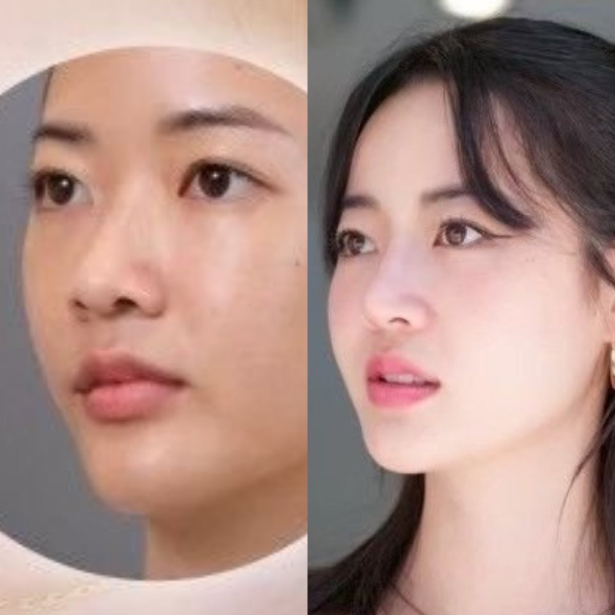 نتائج عملية تجميل الأنف قبل وبعد في Dr. Chen Surgery Hospital International Center، إعادة تشكيل الأنف