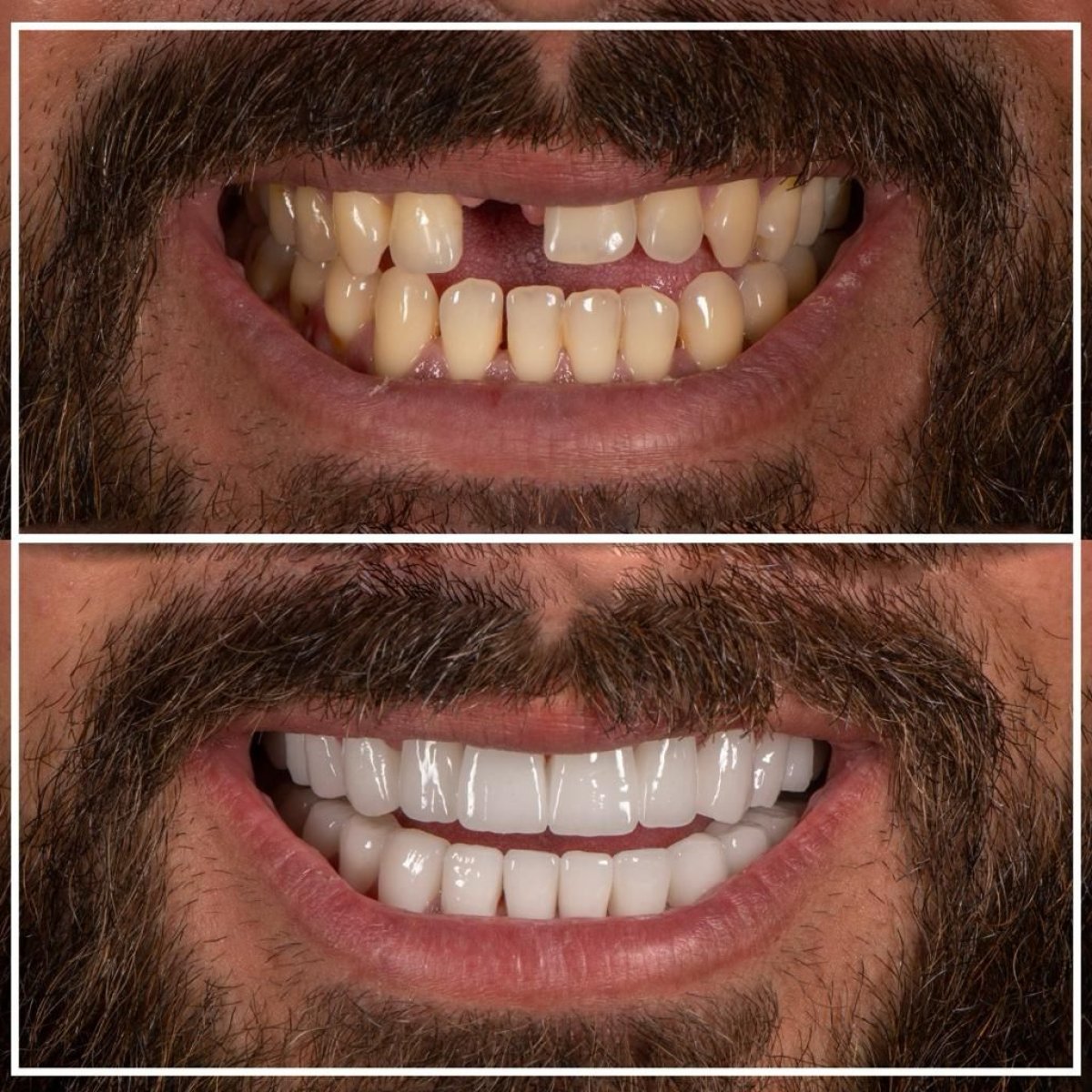 Vorher-nachher-Ergebnis Zahnextraktion bei My Nova Kusadasi Dental Clinic, verbesserte Lächeln