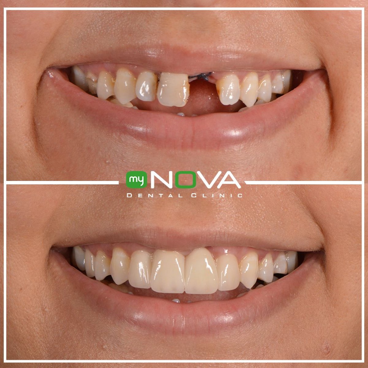 Vorher-nachher-Ergebnis Zahnextraktion bei My Nova Kusadasi Dental Clinic, verbesserte Lächeln