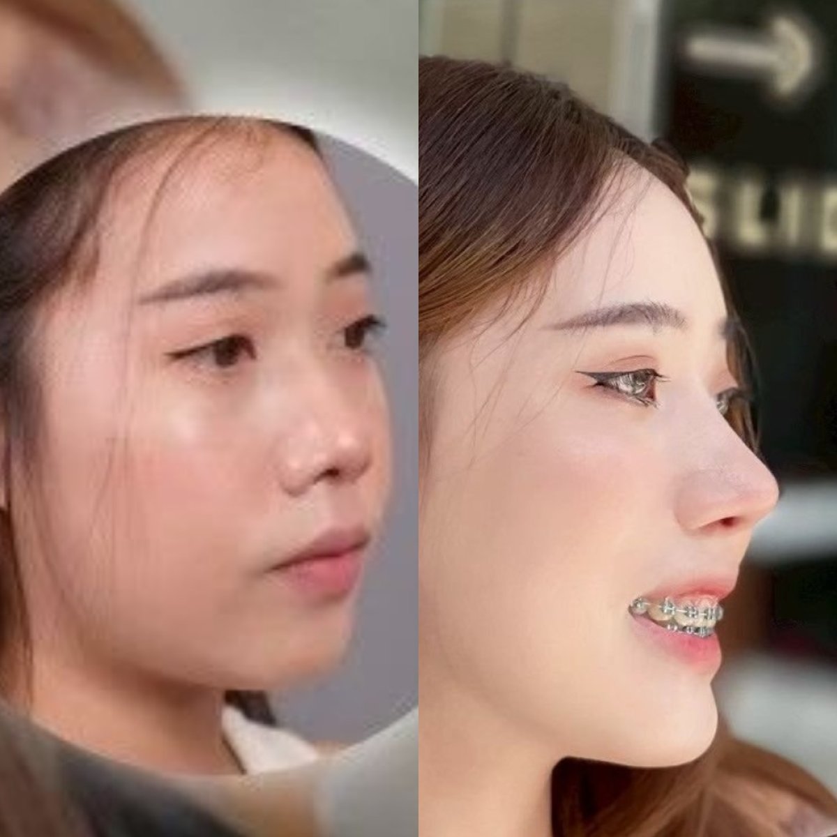 Результат ринопластики до и после в Dr. Chen Surgery Hospital International Center, коррекция носа