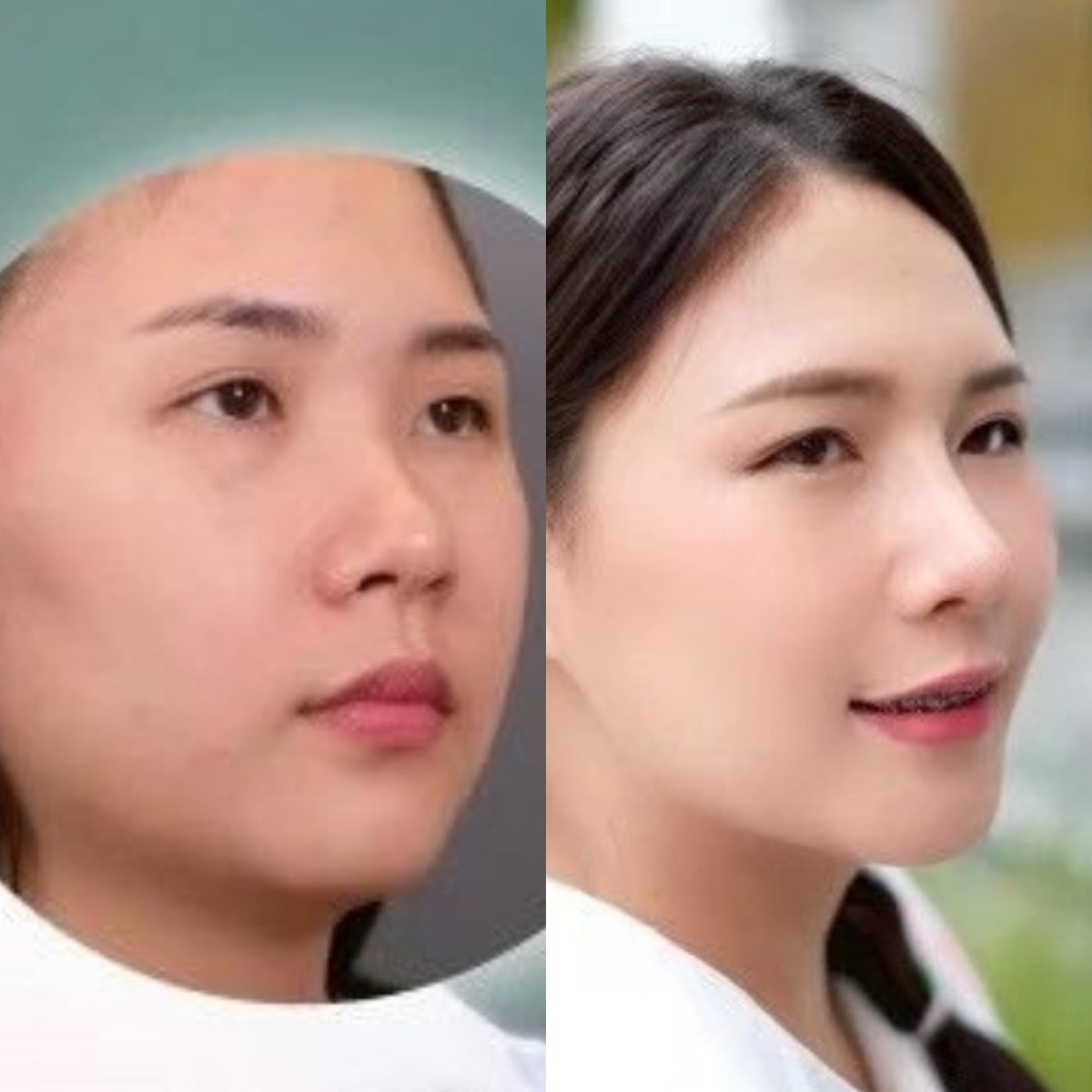 نتيجة عملية تجميل الأنف قبل وبعد في Dr. Chen Surgery Hospital International Center، إعادة تشكيل الأنف