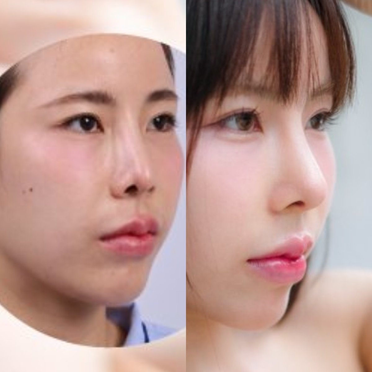 Результаты ринопластики до и после в Dr. Chen Surgery Hospital International Center, коррекция носа