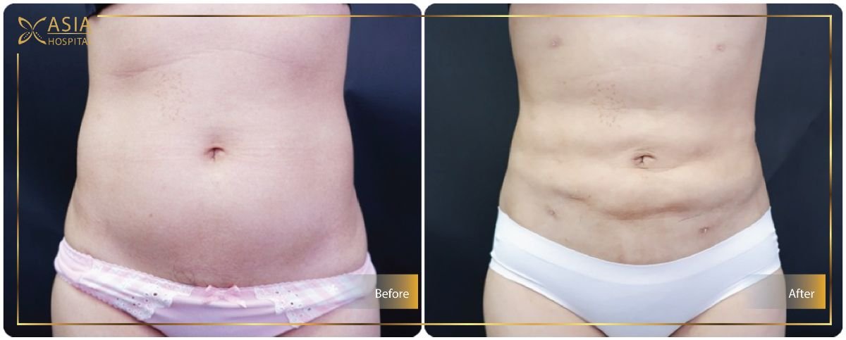 Before and after liposuction results at Asia Cosmetic Hospital, visible abdominal contouring