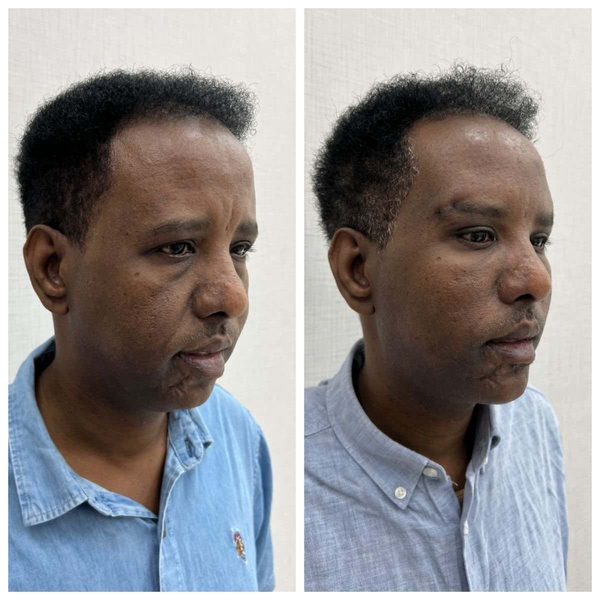Résultats avant/après lifting des sourcils à CE International Hospital, front relevé visible
