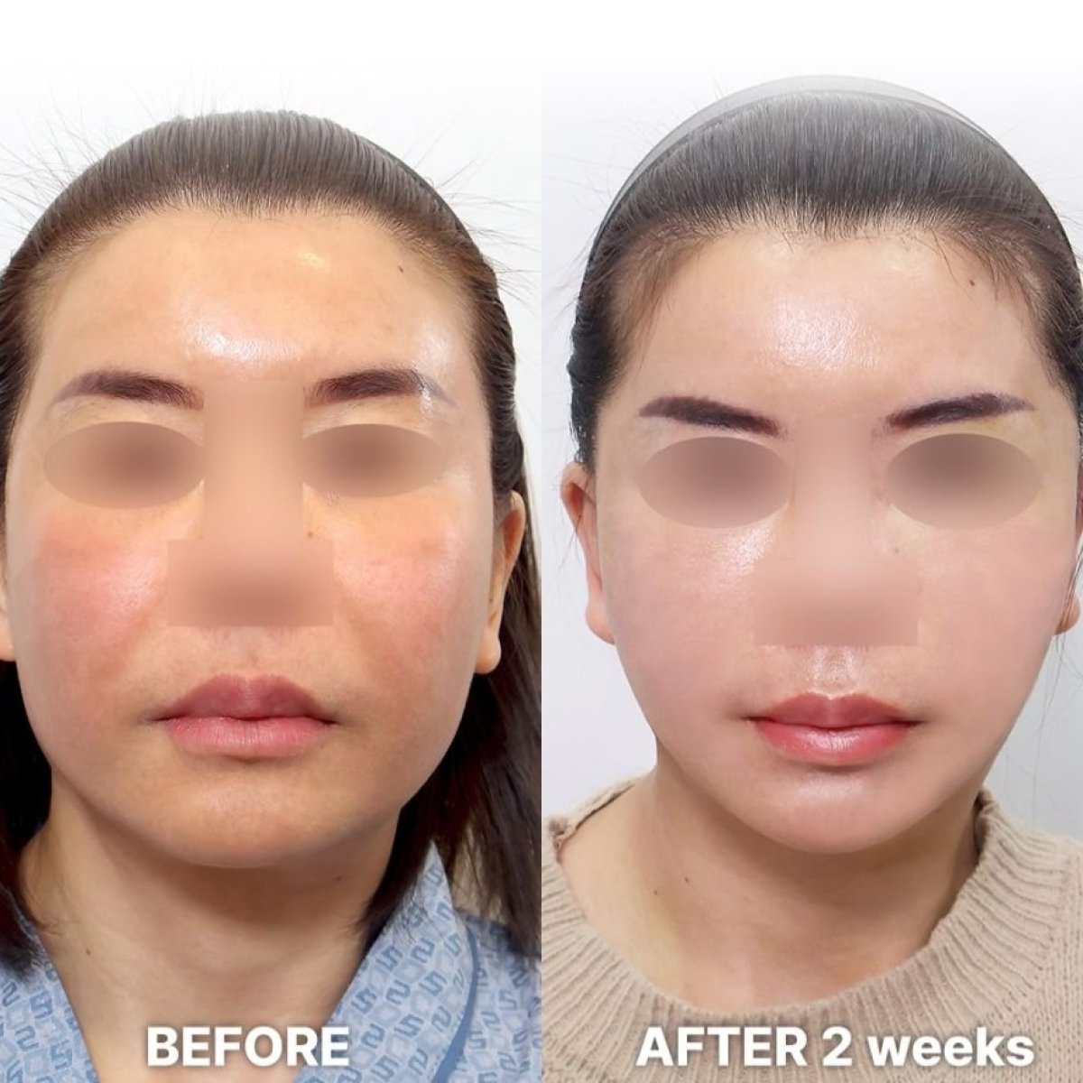 Before and after Deep Plane Facelift results at Returning Plastic Surgery, 2 weeks post-op