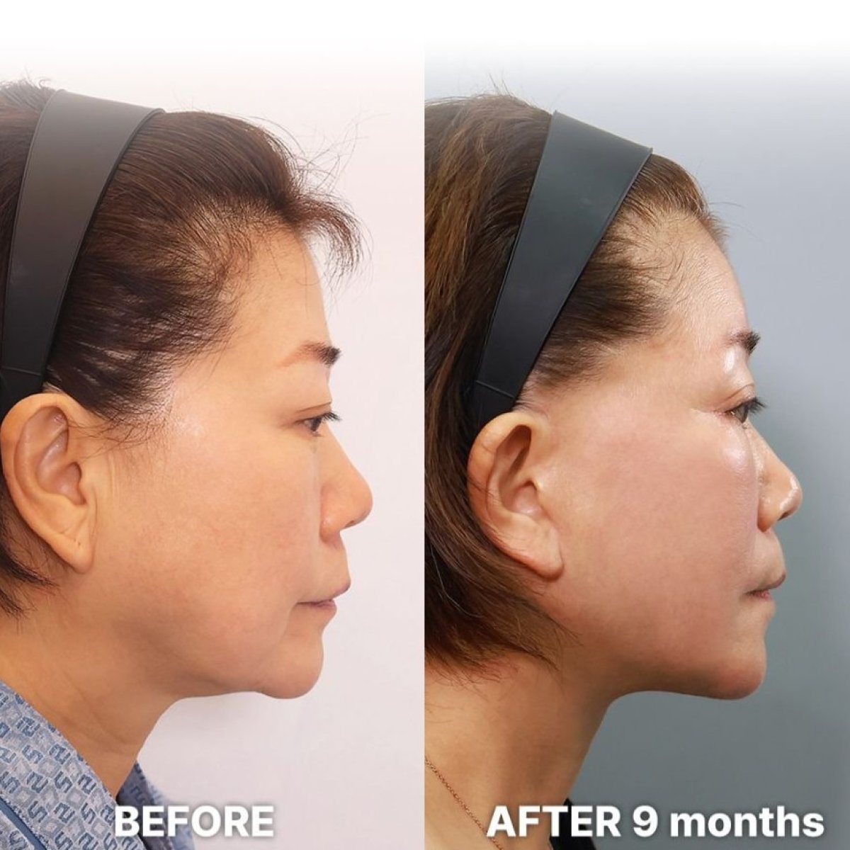 Résultats avant/après lifting deep plane chez Returning Plastic Surgery, 9 mois post-op