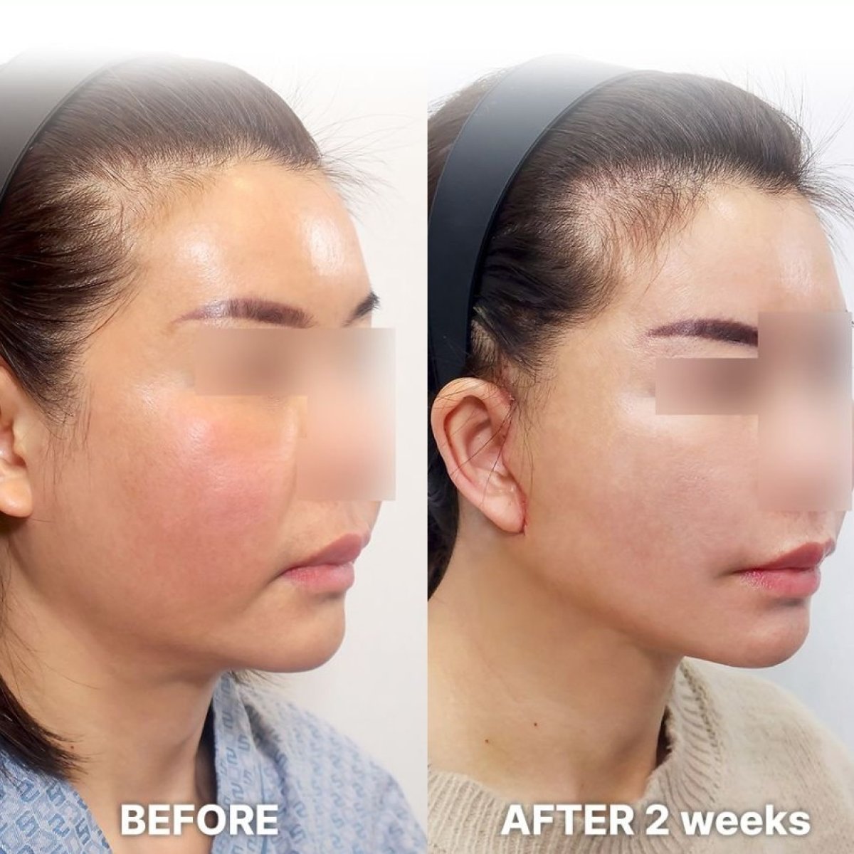 Before and after Deep Plane Facelift results at Returning Plastic Surgery, 2 weeks post-op